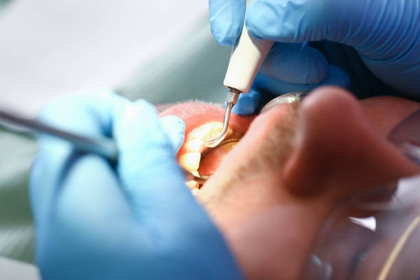 Best Emergency Dental Filling Replacement  in Cambridge, OH